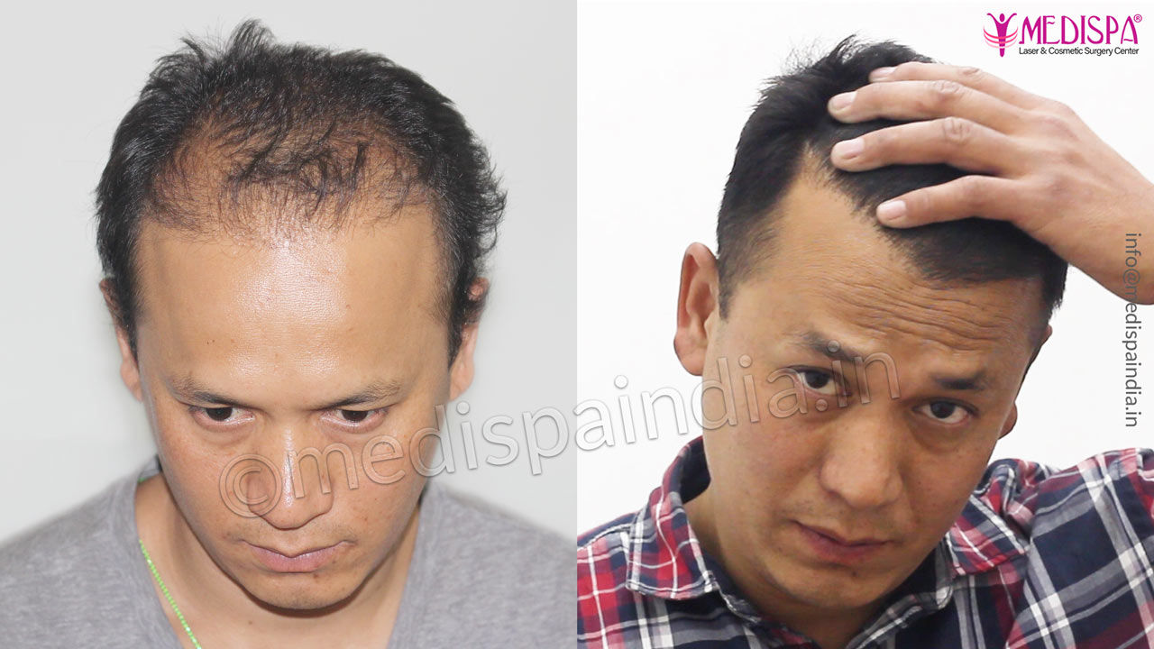 hair transplant results jaipur