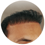 wrong hair transplant correction jaipur
