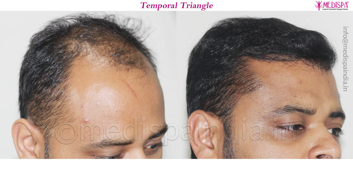 best hair transplant clinic in delhi