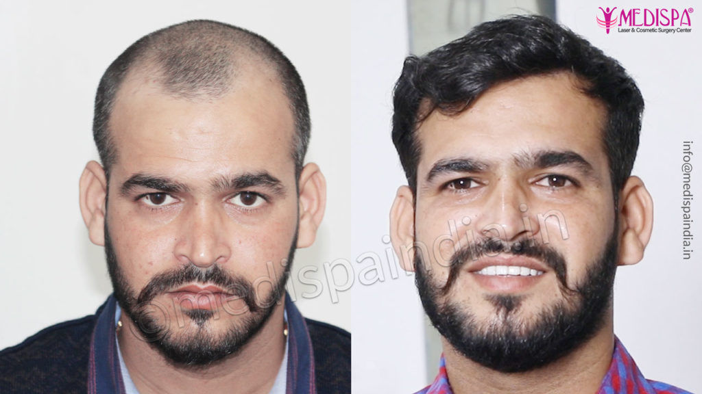 best hair transplant jaipur results