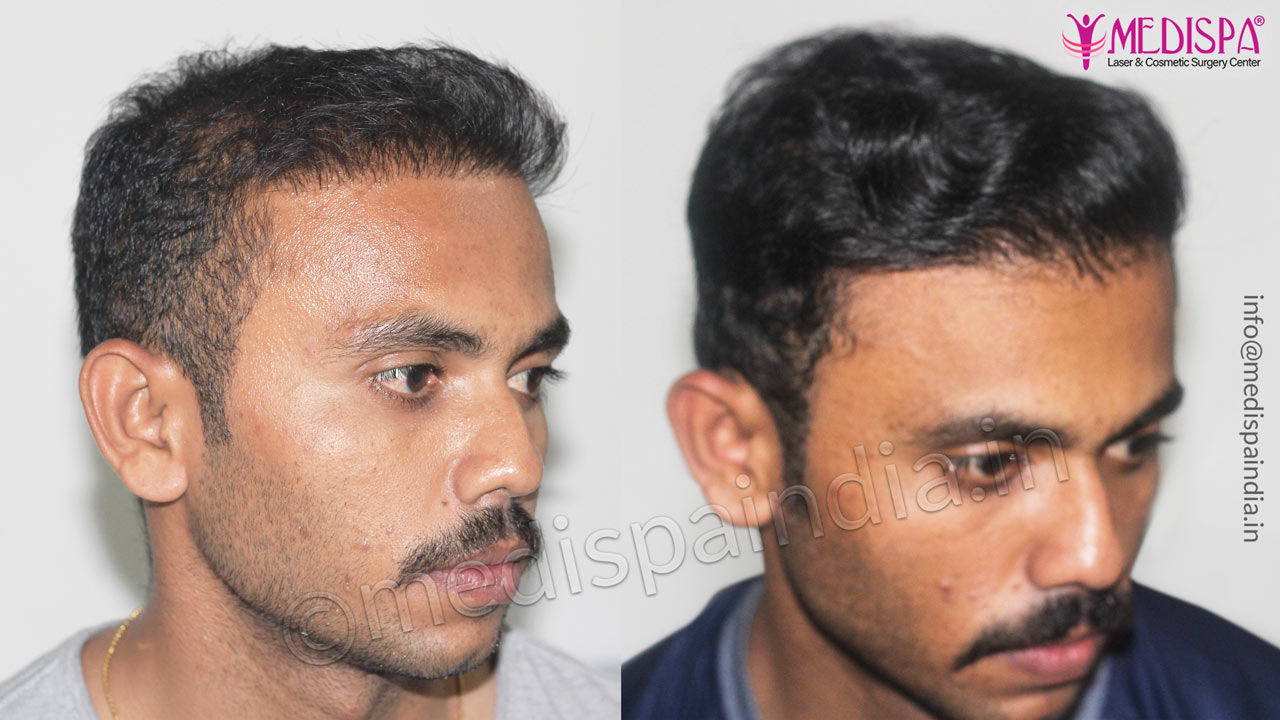 correction hair transplant results jaipur india