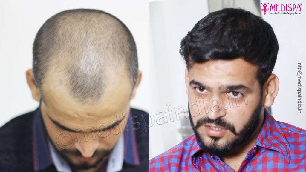 hair transplant in Coimbatore Results