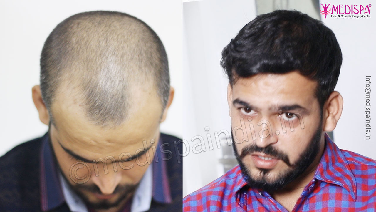 hair transplant in Delhi results