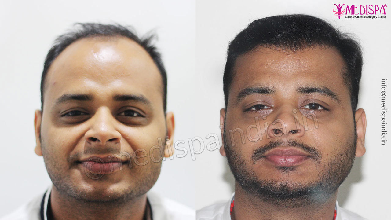 hair transplant cost in dubai