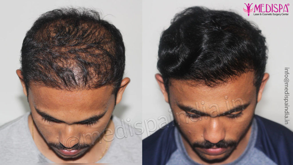 wrong hair transplant before after india