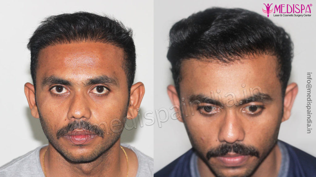 wrong hair transplant correction india