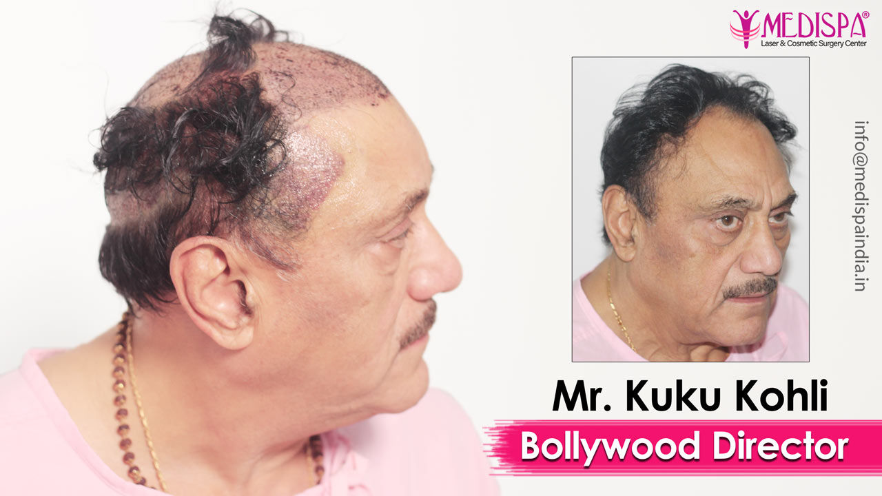 bollywood actor hair transplant results