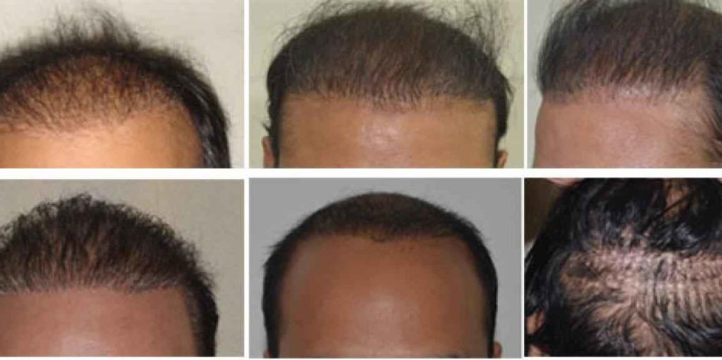 hair-restoration-cost