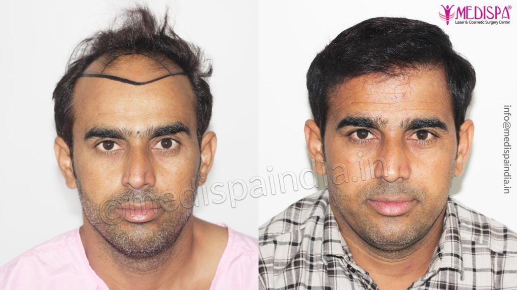 Best hair transplant treatment