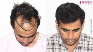 What is a Bio-FUT/ Strip Hair Transplant Procedure