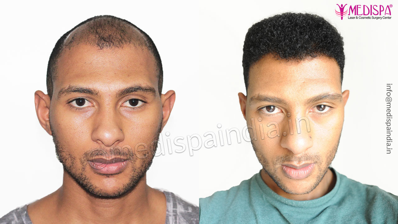 curly hair transplant results