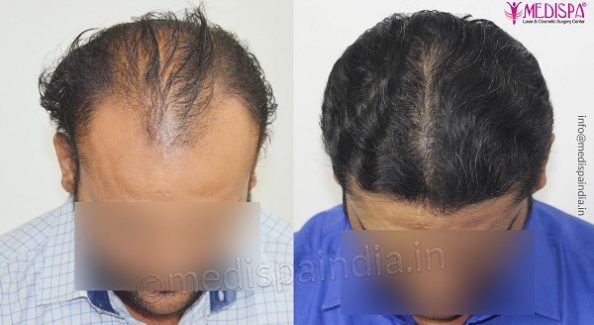 hair transplant clinic in India