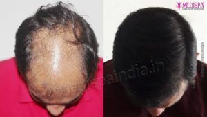 Is It Effective To Have Hair Transplant On Crown Area Of Scalp?