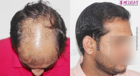 Hair transplant in South Delhi