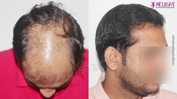 Hair transplant in South Delhi