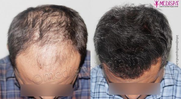 hair transplant in Delhi