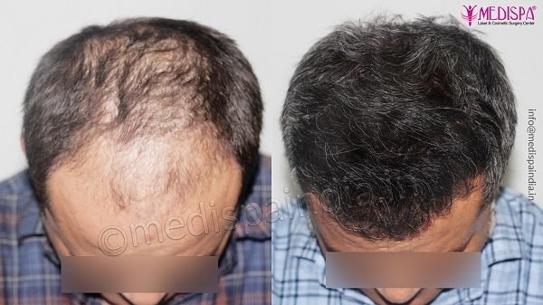 hair transplant in Delhi