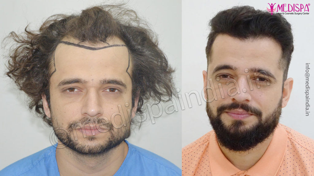 hair transplant usa results