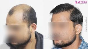 Can Hair Transplant Deliver Permanent Results?