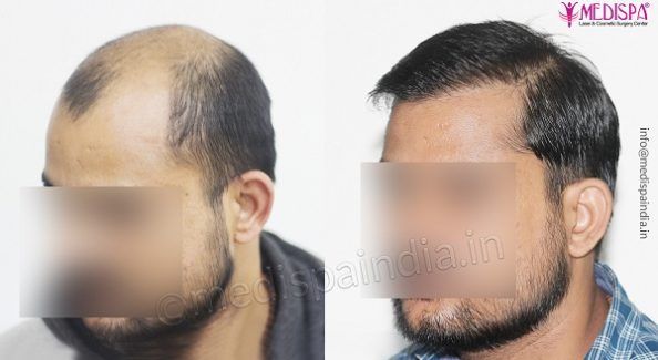 Can Hair Transplant Deliver Permanent Results?