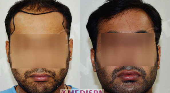 hair transplant in jaipur