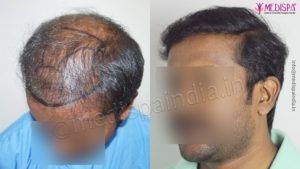 What to consider before choosing Hair Transplant Clinic in Chennai?