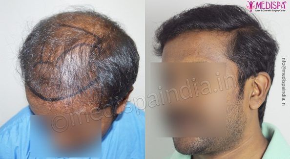 best hair transplant clinic in Chennai