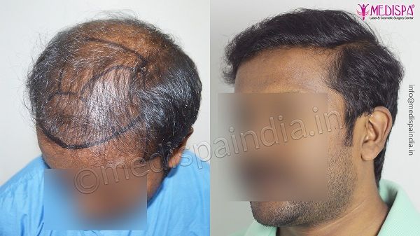 best hair transplant clinic in Chennai
