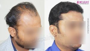 What Should I Look For Before Choosing Hair Transplant Clinic in Jaipur?