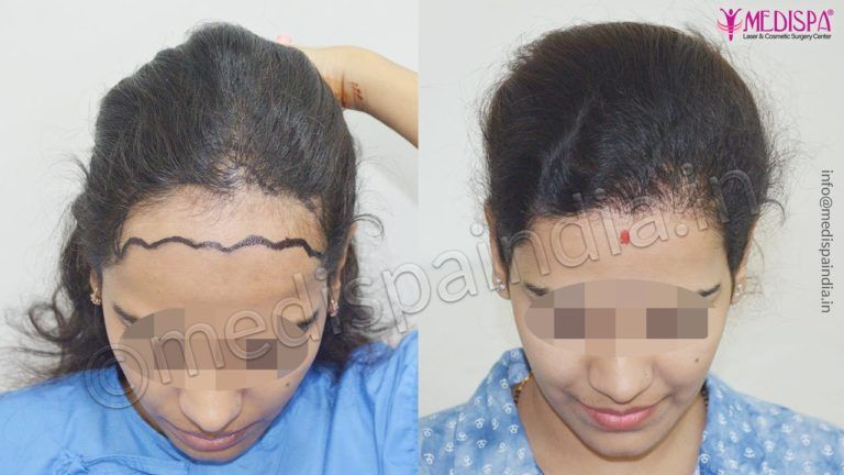 female hair transplant