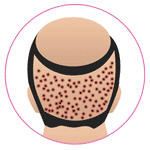 FUE Hair Transplant in Lucknow