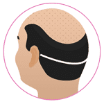 FUT Hair Transplant in Bangalore