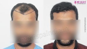 What Are The Precautionary Measures Should Be Followed After Hair Transplant?