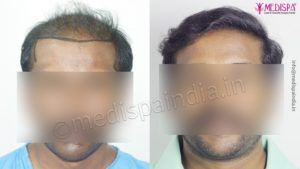 How To Get Safe Hair Transplant Treatment For Hair Loss Issue?