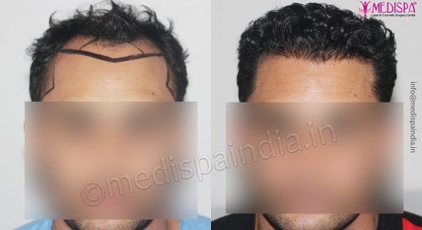 What Are The Safety Protocols And Practices For Hair Transplantation?