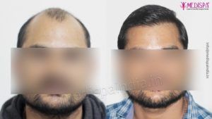 Explain The Significance of FUT Hair Transplant Method