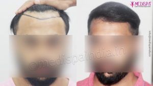 How To Take Care Of The Donor Area After Hair Transplant?