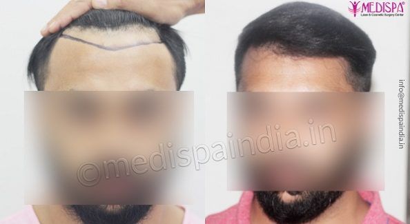 How To Take Care Of The Donor Area After Hair Transplant?