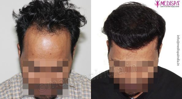 Hair Transplant – Explain The Different Techniques And Their After-Effects