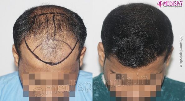 How To Know About The Determining Factors Of Hair Transplant Cost?