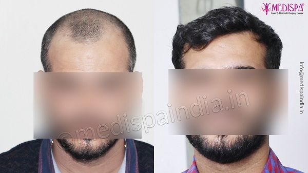 Steps To Get A Successful Hair Transplant Surgery