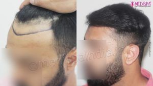 How To Know About The Most Appropriate Technique For Hair Transplantation?