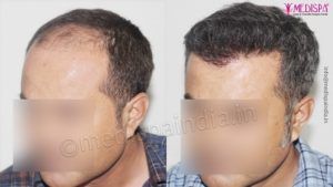 Explain The Success Rate of Hair Transplantation