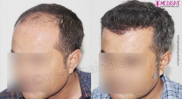 Explain The Success Rate of Hair Transplantation