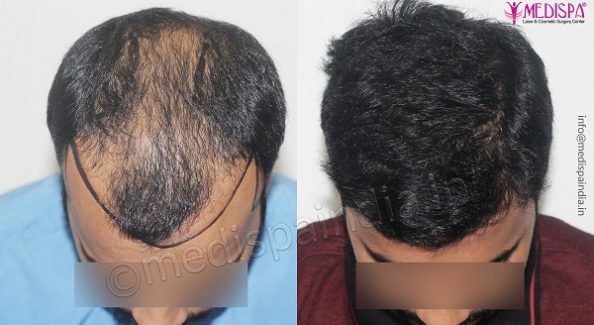 Why Is India The Most Preferred Destination For Hair Transplant?