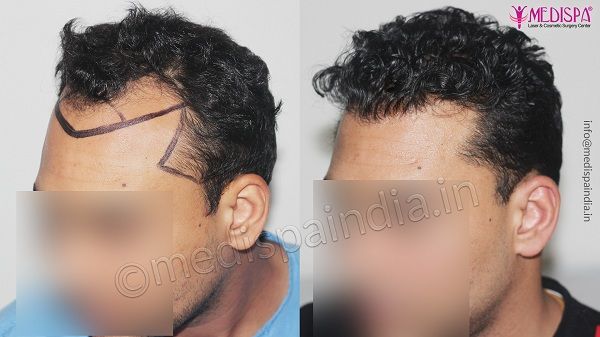Is Hair Transplant A Better Option Than Medication For Hair Loss