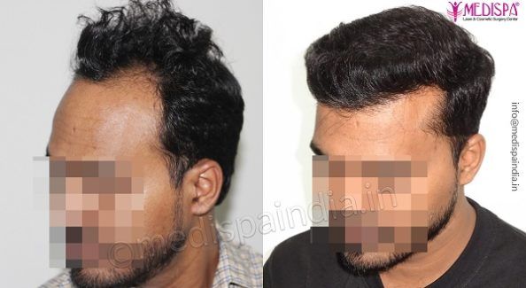 Elaborate The Entire Hair Transplant Process