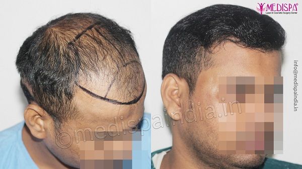 How To Know Which Hair Transplant Technique Is Suitable For Me