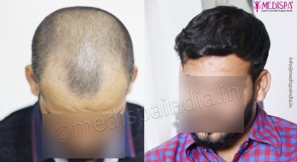 Best Ways To Get The Ideal Results After Hair Transplantation