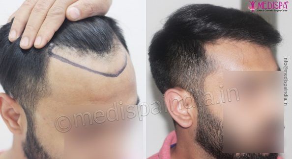 Explain The Qualities Of A Good Hair Transplant Surgeon